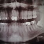 rentgenový snímek čelisti a zubů