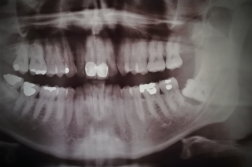 rentgenový snímek čelisti a zubů